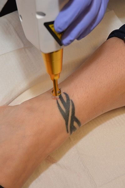 Eliminacion Tatuajes