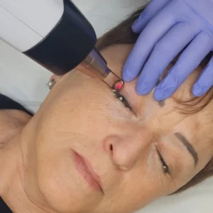 Lente Ocular para Despigmentación de ojos - Imagen 2